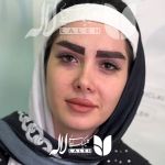 کاشت ابرو